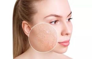 Winter Skin Sensitivity