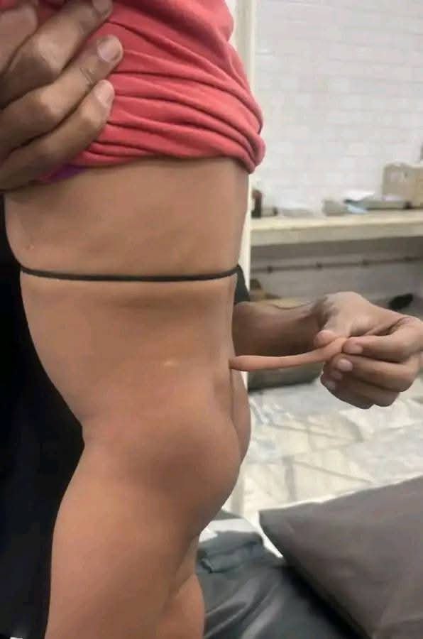 डेढ़ साल के बच्चे की पीठ से निकली ‘पूंछ