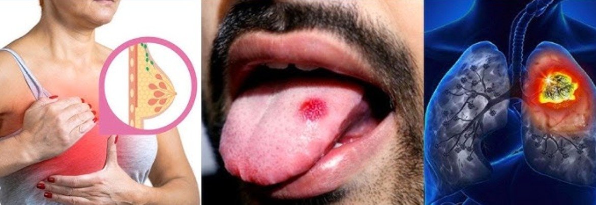 Cancer Treatment: How to avoid cancer!