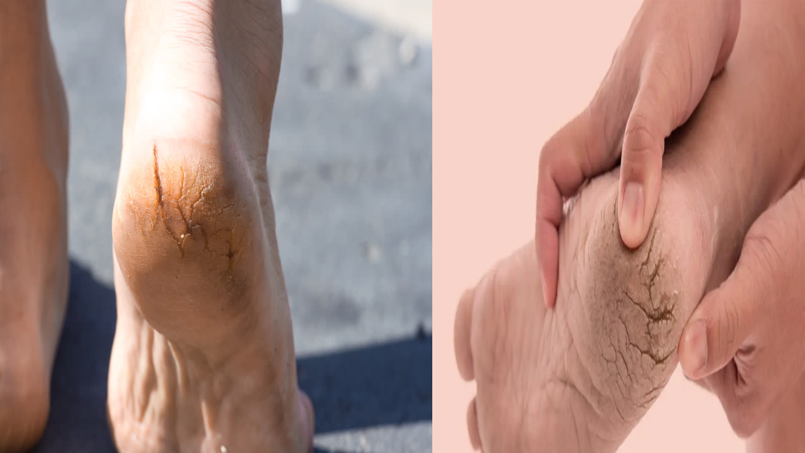 Heel Repairs: फटी एड़ियों से पाना है छुटकारा? कोमल और खूबसूरत पैरों के लिए अपनाएं ये आसान टिप्स