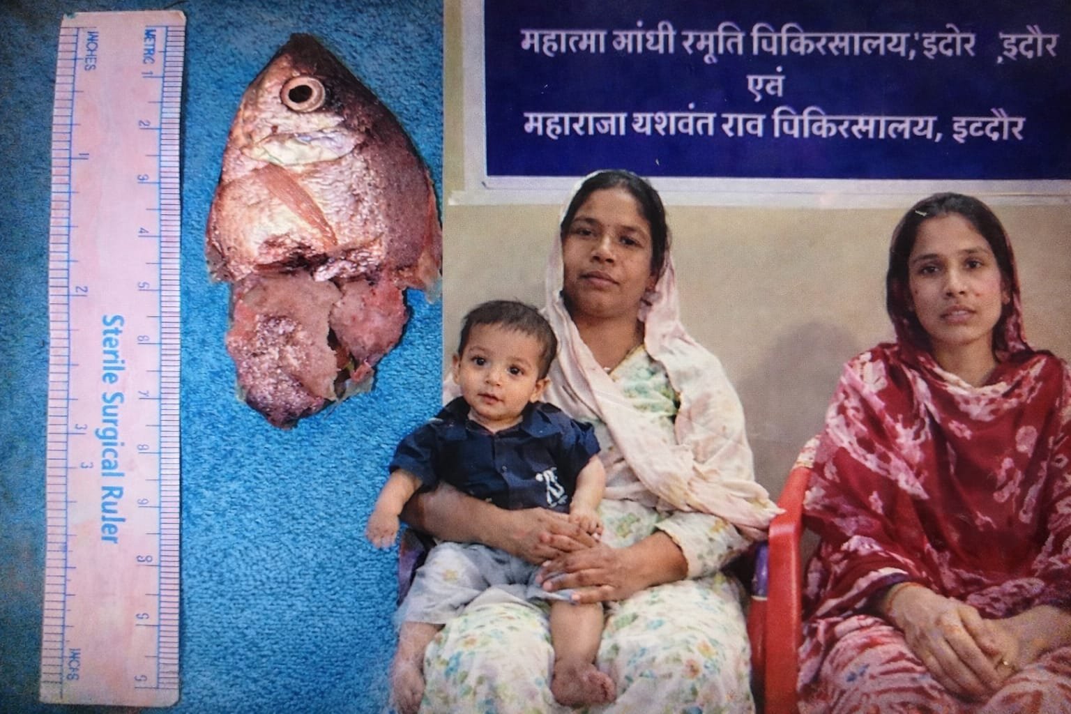 एक साल के बच्चे ने निगली जिंदा मछली, ऑपरेशन कर डॉक्टरों ने बचाई जान