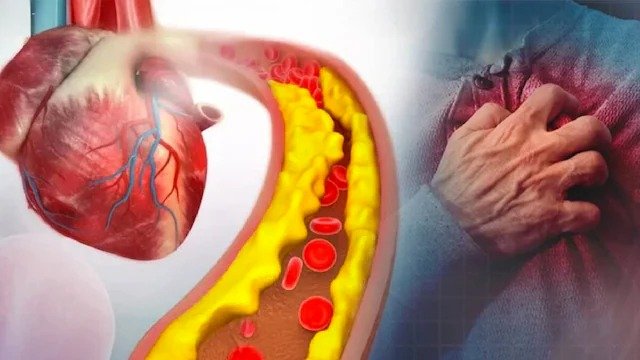 New Gene Therapy for Bad Cholesterol