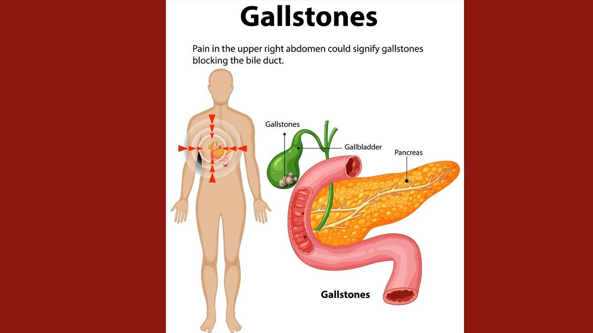 Gallbladder Disease: