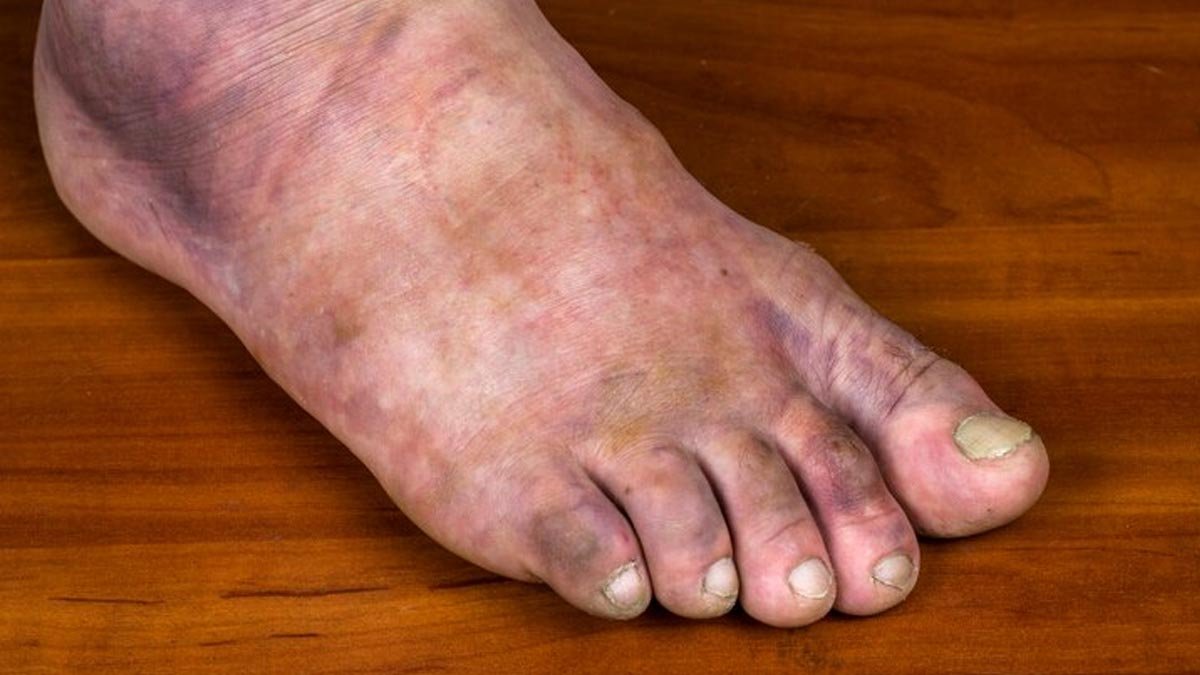 Leg Swelling: