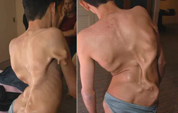 Rare Disease: आपसी रिश्तों में शादी बनी टेढ़ी हड्डियो का कारण