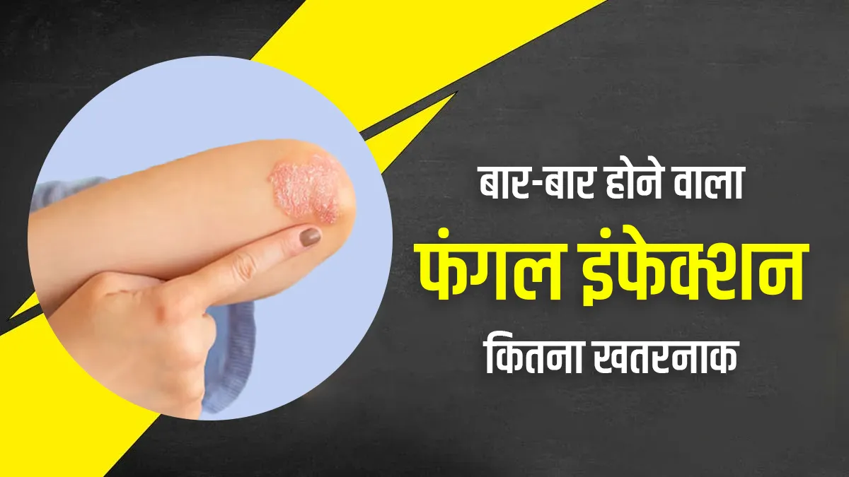 Fungal Infection: