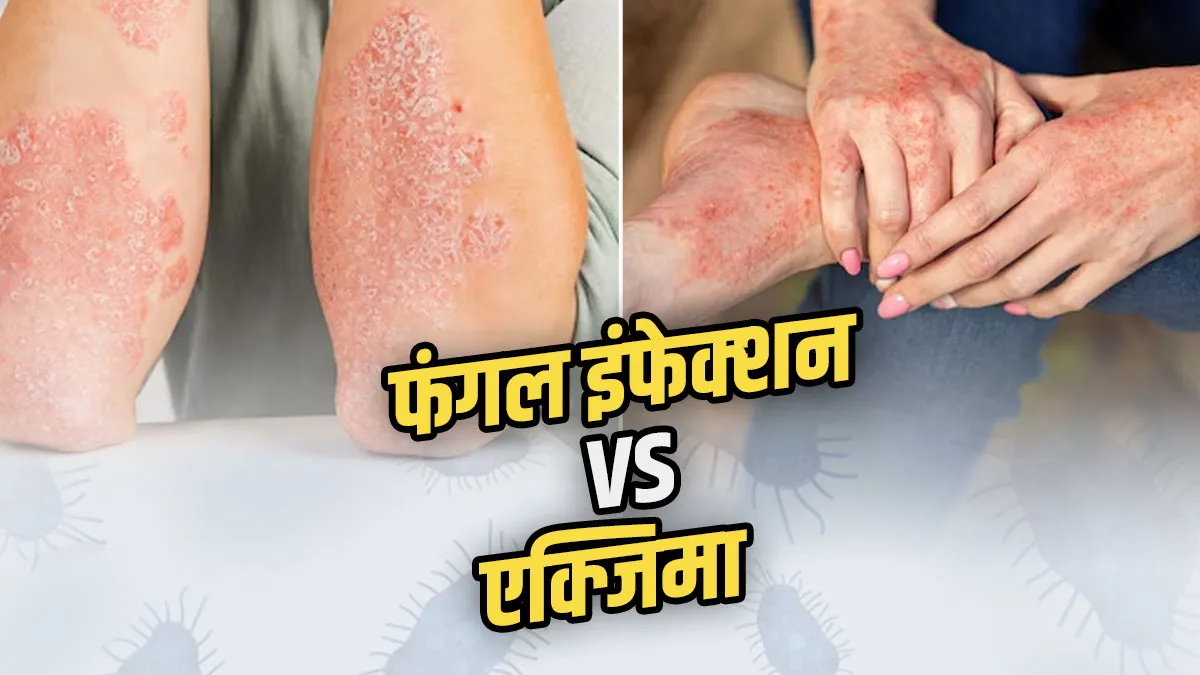 Fungal Infection vs Eczema: