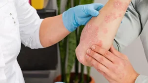 Psoriasis Disease:
